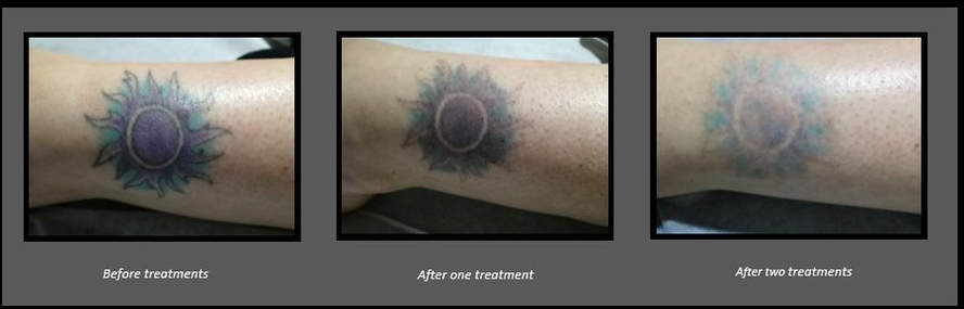 Tattoo Removal Procedure | Alma